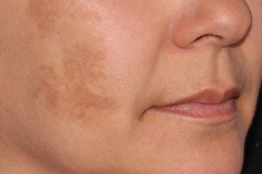 Melasma