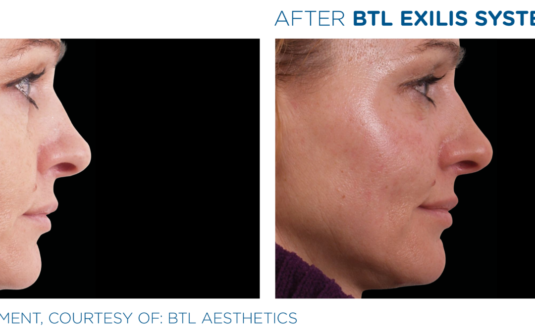 BTL Exilis